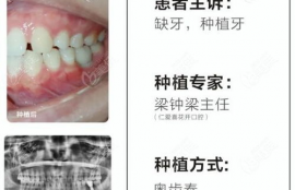 德国种植体icx怎么样,种植牙哪个品牌好