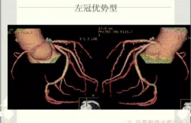 冠脉lcx是什么意思,什么是冠脉LCX ?