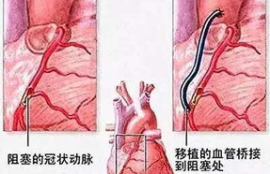 心脏lcx血管堵塞的后果,二、LCX血管堵塞的结果