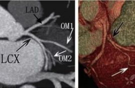 冠状动脉lcx是什么,了解冠状动脉LCX:重要性和功能
