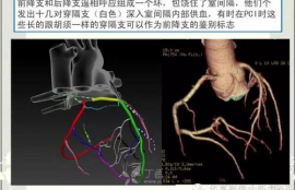 冠脉lcx是什么意思,什么是冠脉LCX ?